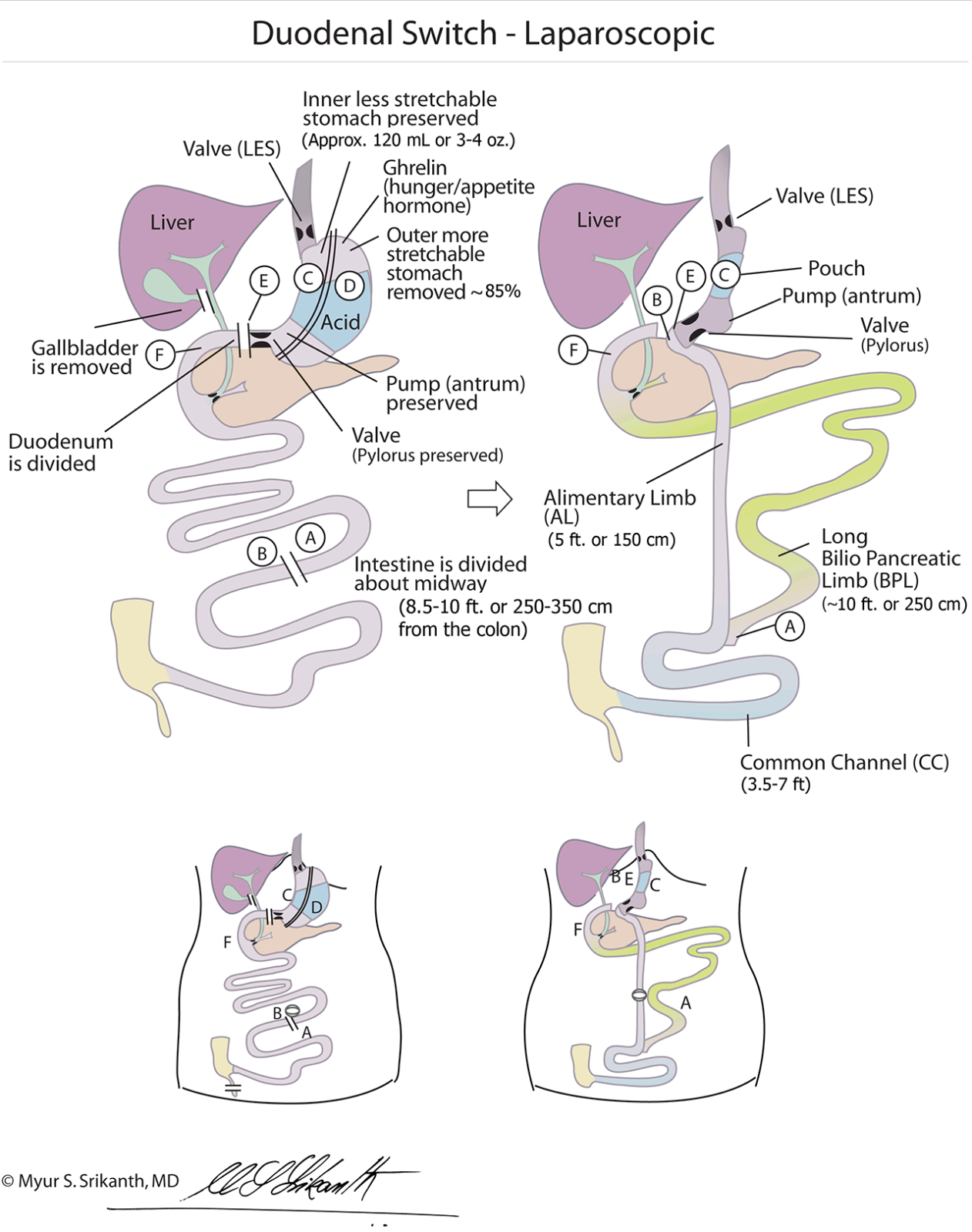 What Is A Modified Duodenal Switch