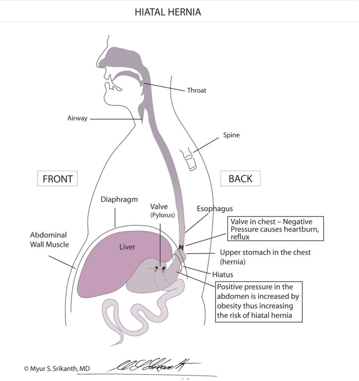 Acid Reflux Surgery In Seattle Gerd Surgery Options