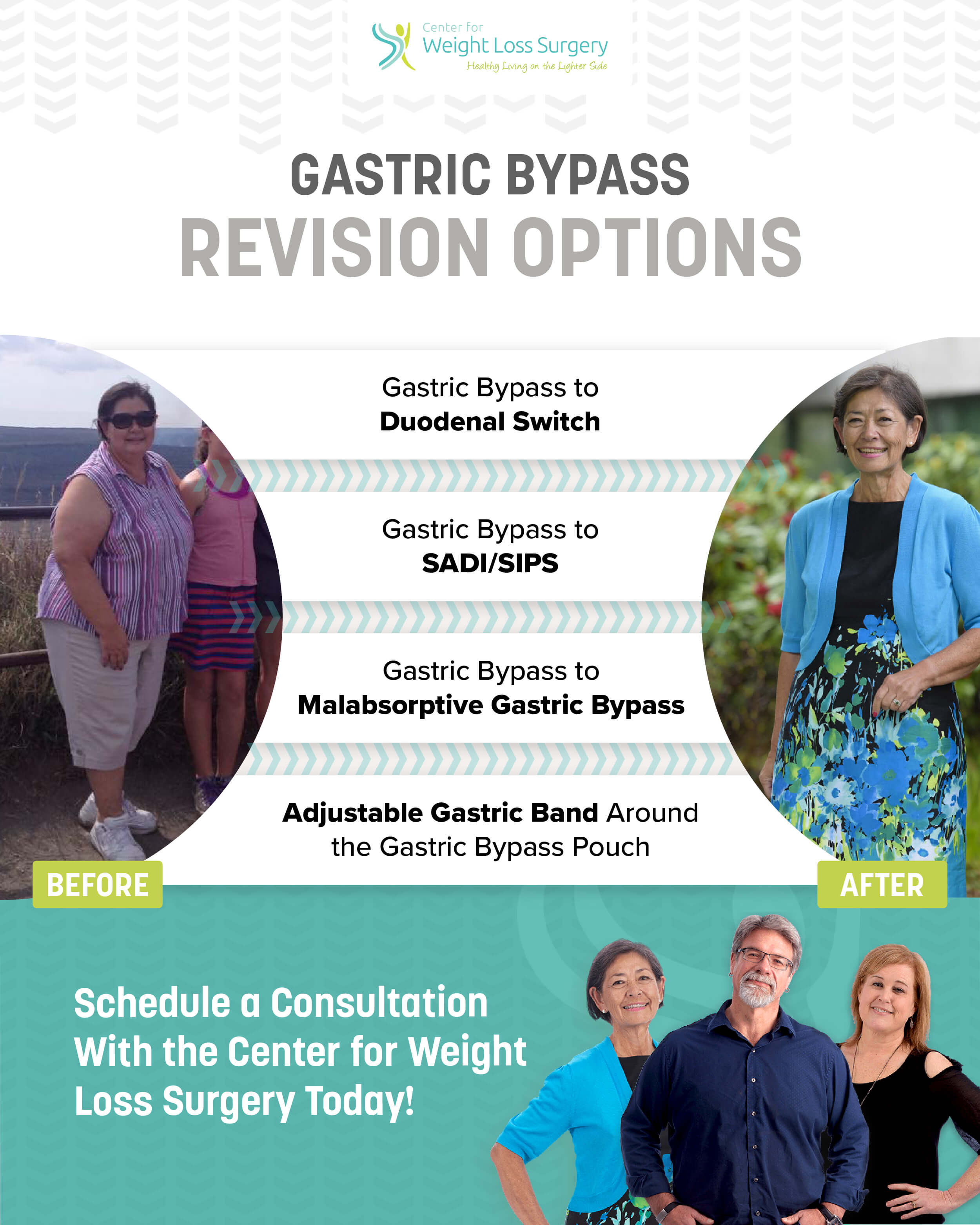 bariatric revision surgery options to revise a gastric bypass